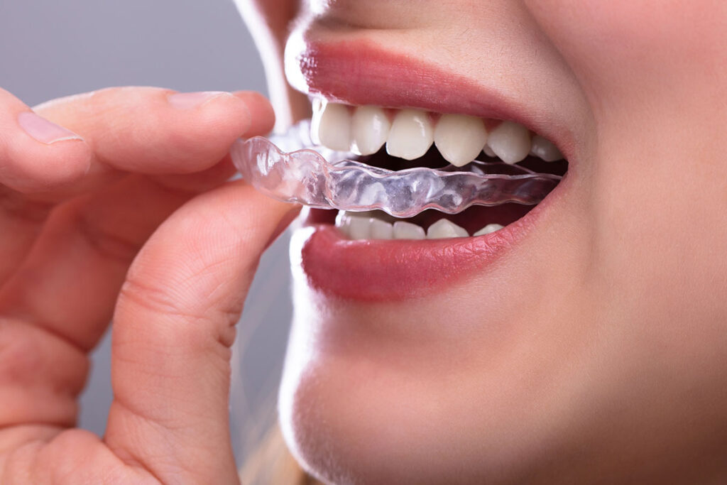 Invisalign Competitors