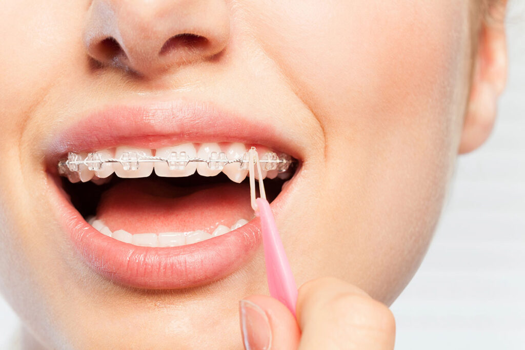 Rubber Bands for Braces