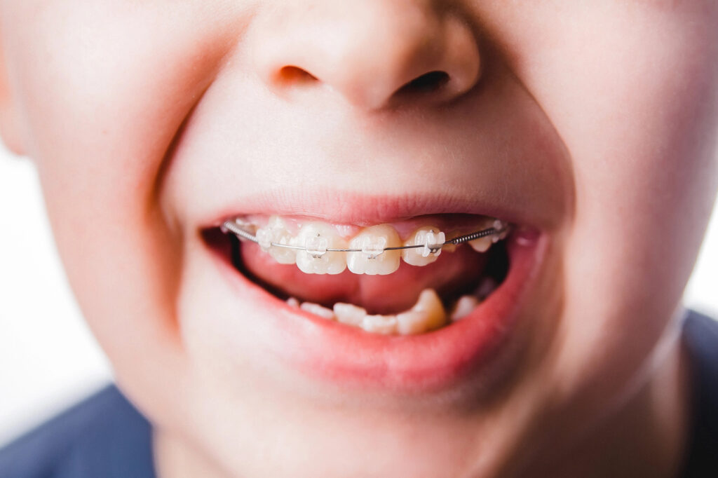 common orthodontic disorders